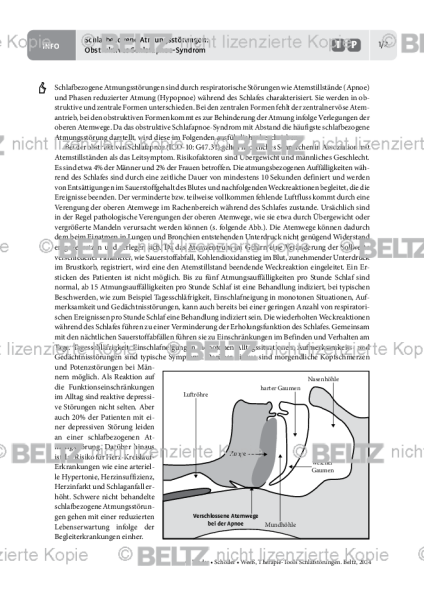 Schlafstörungen: Schlafbezogene Atmungsstörungen Obstruktives Schlafapnoe-Syndrom